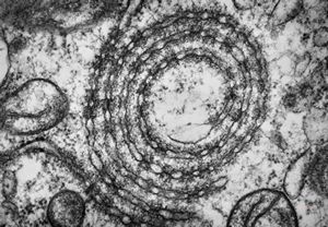 M,21y. | annulate lamellae - intracranial germinoma M,21y. | annulate lamellae - intracranial germinoma